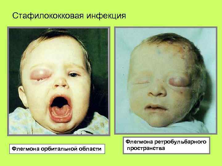 Стафилококковая инфекция Флегмона орбитальной области Флегмона ретробульбарного пространства 