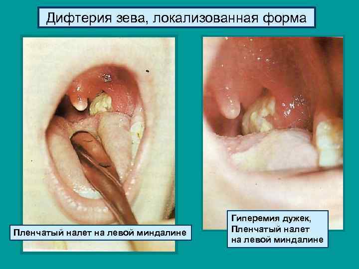 Дифтерия зева, локализованная форма Пленчатый налет на левой миндалине Гиперемия дужек, Пленчатый налет на