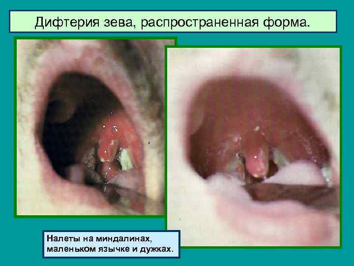 Дифтерия зева, распространенная форма. Налеты на миндалинах, маленьком язычке и дужках. 
