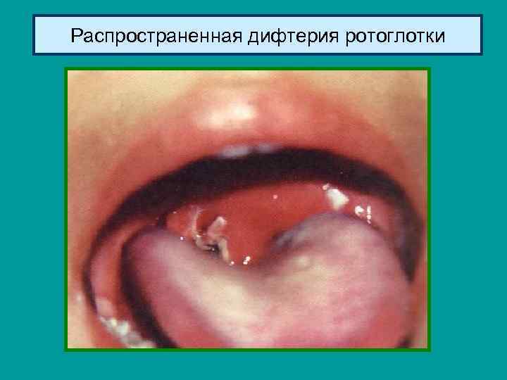 Распространенная дифтерия ротоглотки 
