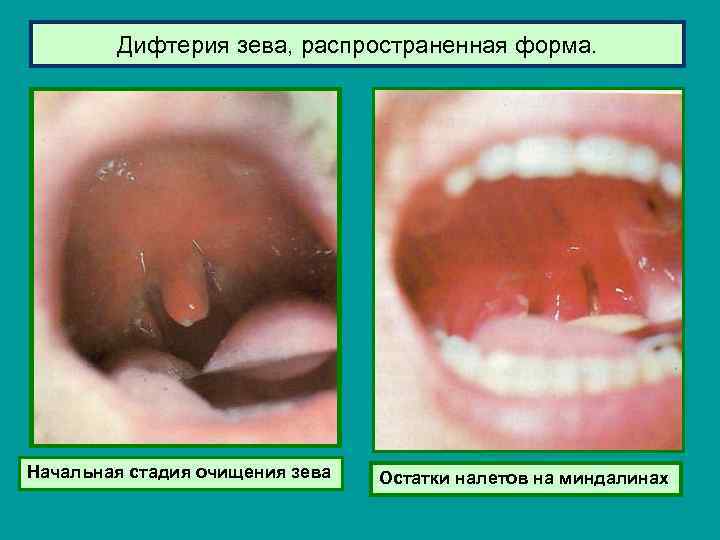 Дифтерия зева, распространенная форма. Начальная стадия очищения зева Остатки налетов на миндалинах 