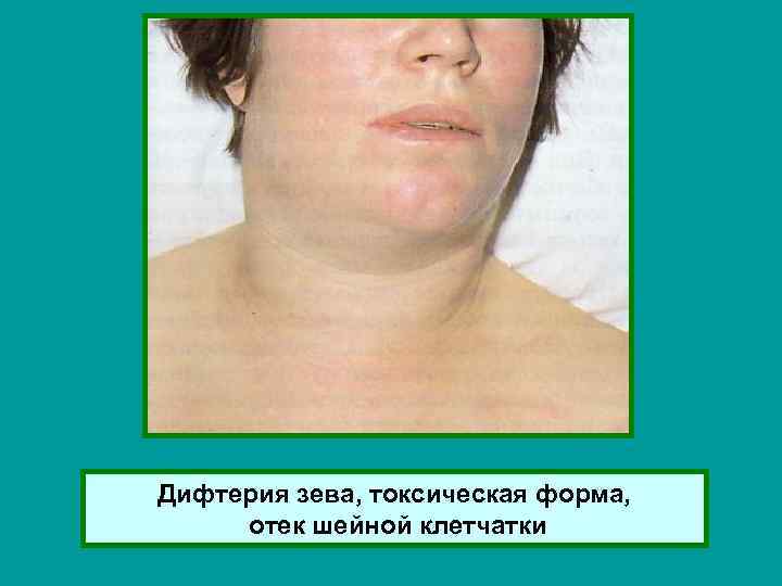Дифтерия зева, токсическая форма, отек шейной клетчатки 