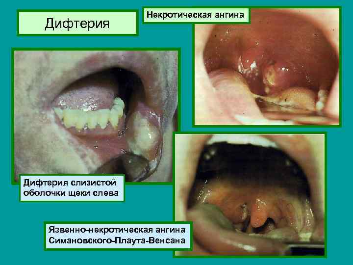 Дифтерия Некротическая ангина Дифтерия слизистой оболочки щеки слева Язвенно-некротическая ангина Симановского-Плаута-Венсана 