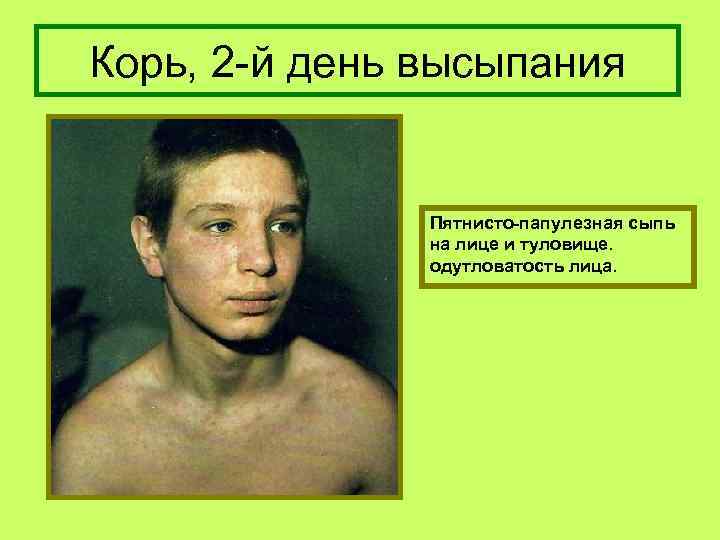 Корь, 2 -й день высыпания Пятнисто-папулезная сыпь на лице и туловище. одутловатость лица. 
