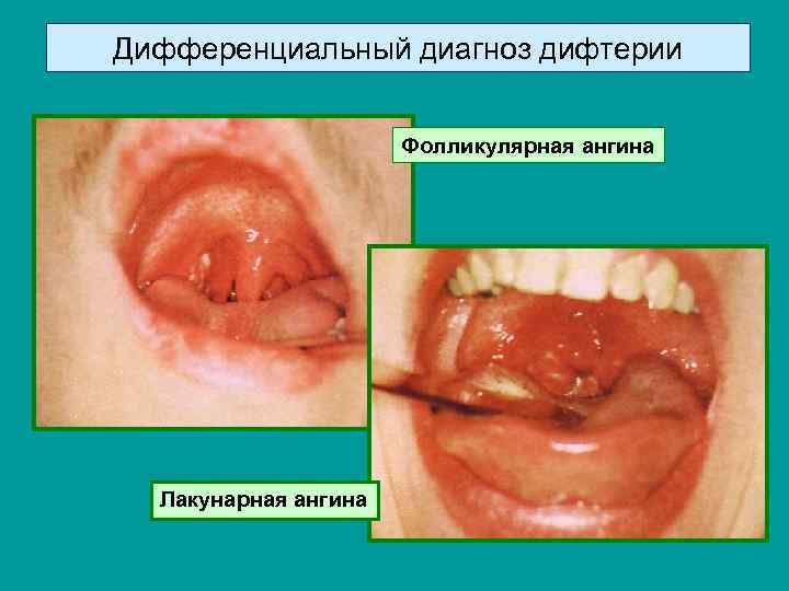 Дифференциальный диагноз дифтерии Фолликулярная ангина Лакунарная ангина 