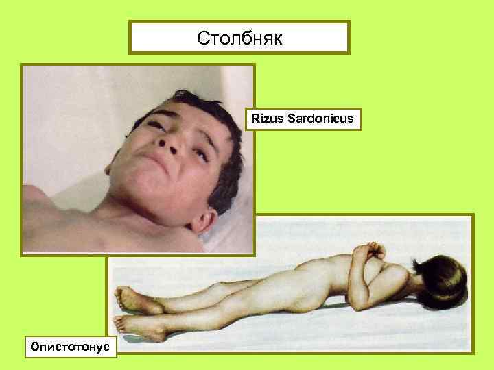 Столбняк Rizus Sardonicus Опистотонус 