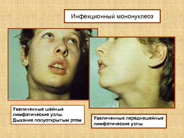 Инфекционный мононуклеоз Увеличенные шейные лимфатические узлы. Дыхание полуоткрытым ртом Увеличенные лереднешейные лимфатические узлы 