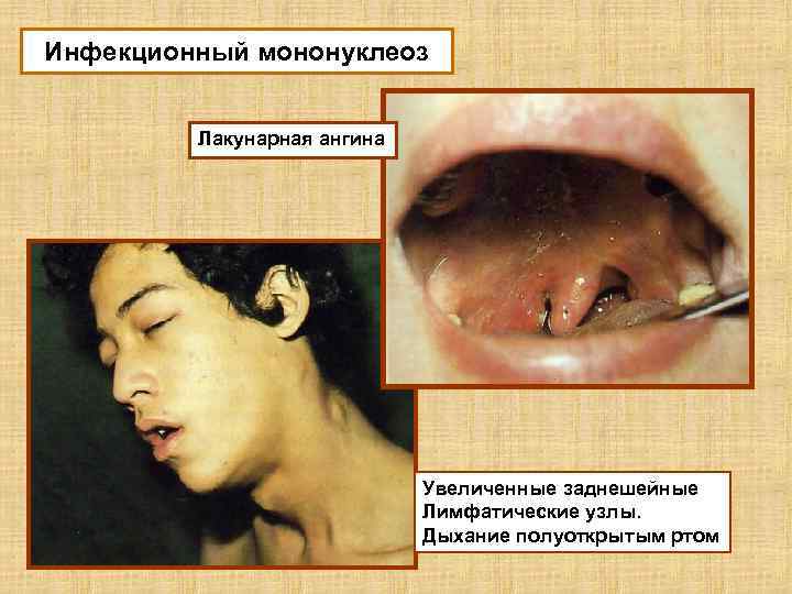 Инфекционный мононуклеоз Лакунарная ангина Увеличенные заднешейные Лимфатические узлы. Дыхание полуоткрытым ртом 