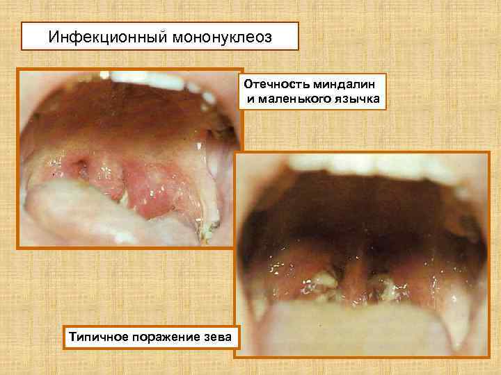 Инфекционный мононуклеоз Отечность миндалин и маленького язычка Типичное поражение зева 