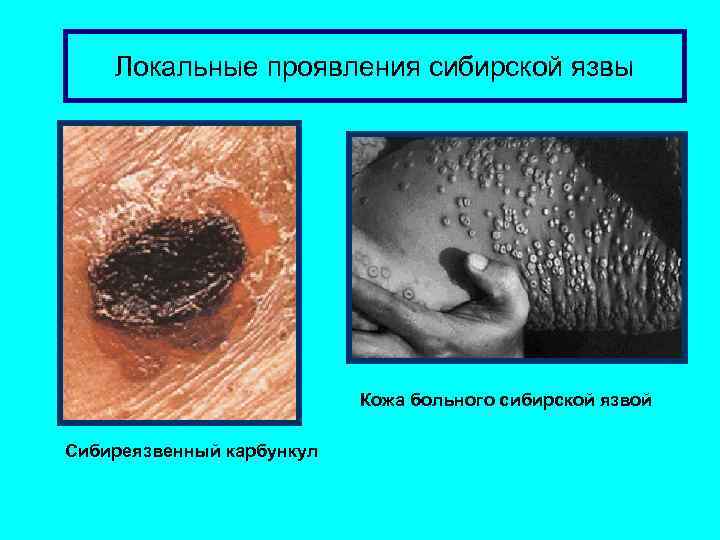 Локальные проявления сибирской язвы Кожа больного сибирской язвой Сибиреязвенный карбункул 
