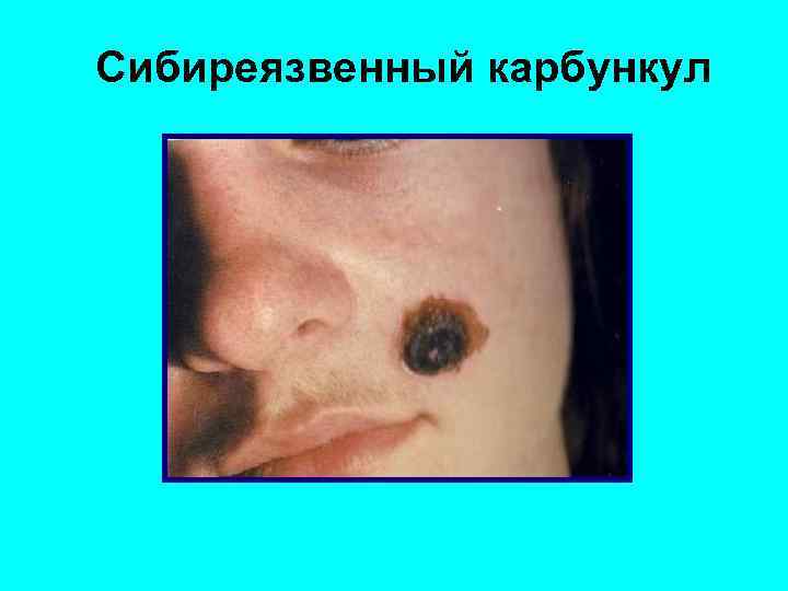 Сибиреязвенный карбункул 