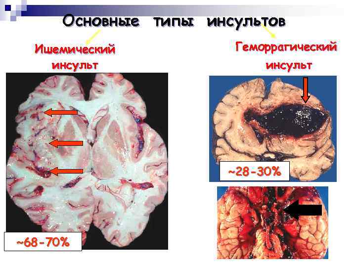 Основные типы инсультов Ишемический инсульт Геморрагический инсульт ~28 -30% ~68 -70% 