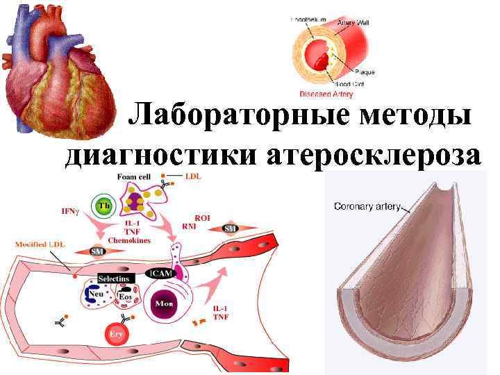  Лабораторные методы диагностики атеросклероза 