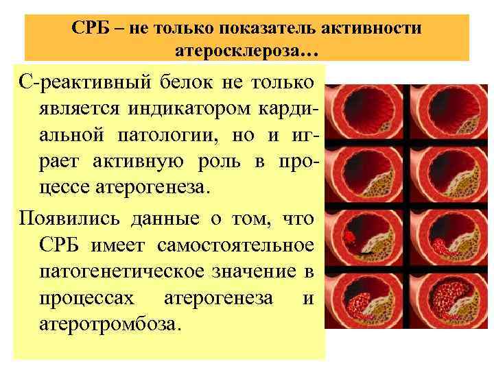 СРБ – не только показатель активности атеросклероза… С-реактивный белок не только является индикатором кардиальной