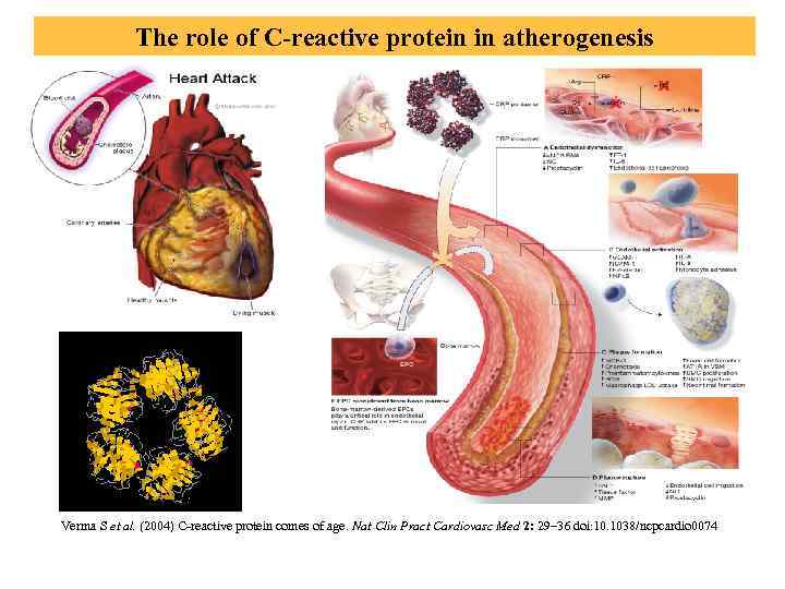 The role of C-reactive protein in atherogenesis Verma S et al. (2004) C-reactive protein