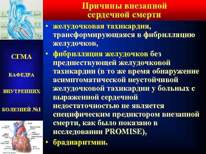 Причины внезапной сердечной смерти СГМА КАФЕДРА ВНУТРЕННИХ БОЛЕЗНЕЙ № 1 • желудочковая тахикардия, трансформирующаяся