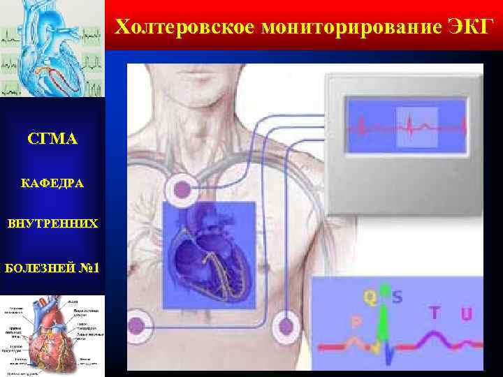 Холтеровское мониторирование ЭКГ СГМА КАФЕДРА ВНУТРЕННИХ БОЛЕЗНЕЙ № 1 