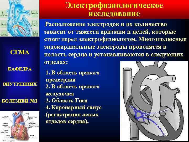 Электрофизиологическое исследование СГМА Расположение электродов и их количество зависит от тяжести аритмии и целей,
