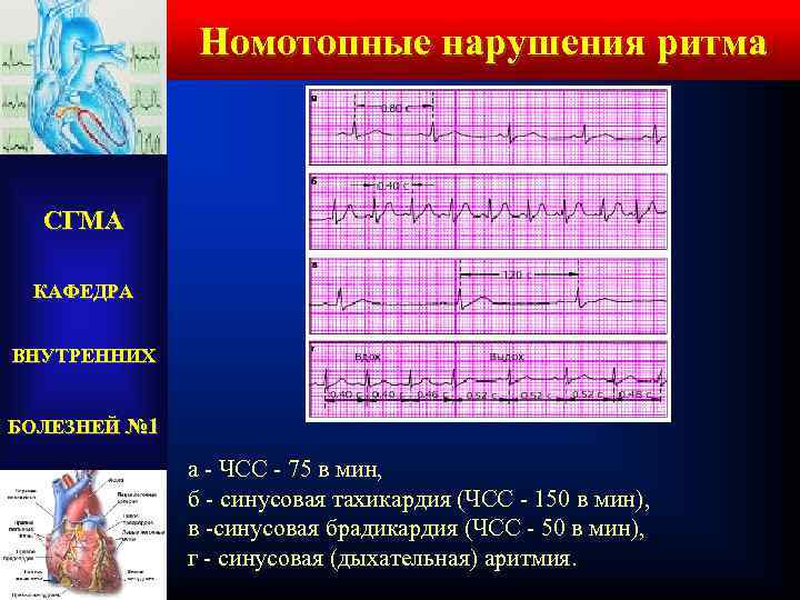 Номотопные нарушения ритма СГМА КАФЕДРА ВНУТРЕННИХ БОЛЕЗНЕЙ № 1 а - ЧСС - 75