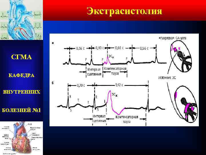 Экстрасистолия СГМА КАФЕДРА ВНУТРЕННИХ БОЛЕЗНЕЙ № 1 