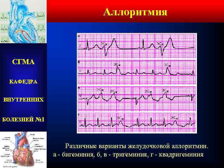 Аллоритмия СГМА КАФЕДРА ВНУТРЕННИХ БОЛЕЗНЕЙ № 1 Различные варианты желудочковой аллоритмии. а - бигеминия,