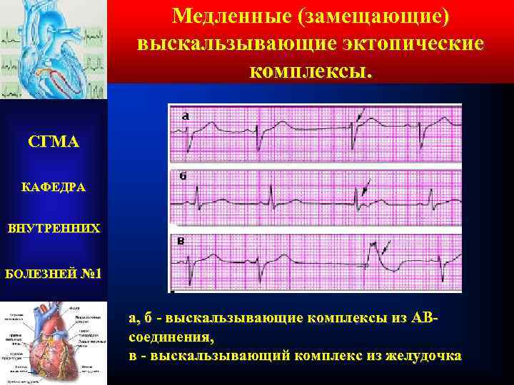 Медленные (замещающие) выскальзывающие эктопические комплексы. СГМА КАФЕДРА ВНУТРЕННИХ БОЛЕЗНЕЙ № 1 а, б -