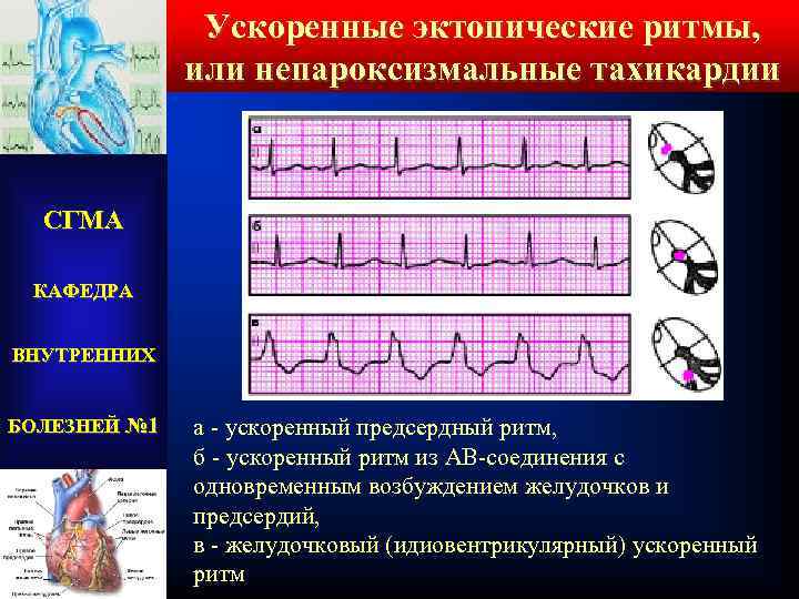 Ускоренные эктопические ритмы, или непароксизмальные тахикардии СГМА КАФЕДРА ВНУТРЕННИХ БОЛЕЗНЕЙ № 1 а -