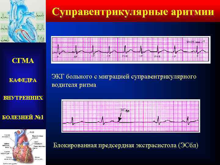 Суправентрикулярные аритмии СГМА КАФЕДРА ЭКГ больного с миграцией суправентрикулярного водителя ритма ВНУТРЕННИХ БОЛЕЗНЕЙ №