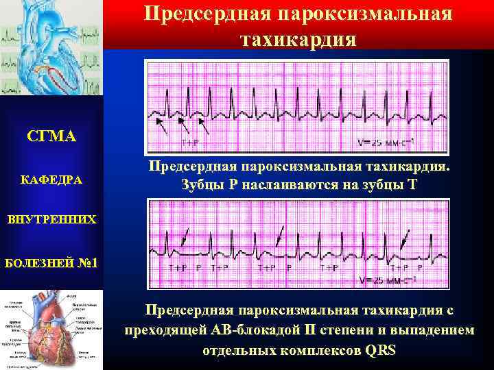 Предсердная пароксизмальная тахикардия СГМА КАФЕДРА Предсердная пароксизмальная тахикардия. Зубцы Р наслаиваются на зубцы Т