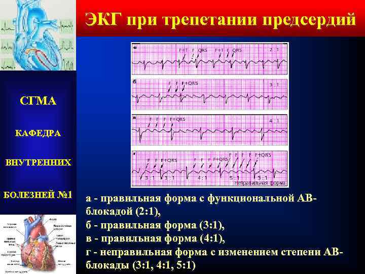 ЭКГ при трепетании предсердий СГМА КАФЕДРА ВНУТРЕННИХ БОЛЕЗНЕЙ № 1 а - правильная форма
