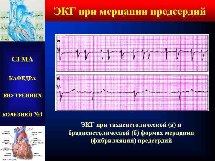 ЭКГ при мерцании предсердий СГМА КАФЕДРА ВНУТРЕННИХ БОЛЕЗНЕЙ № 1 ЭКГ при тахисистолической (а)