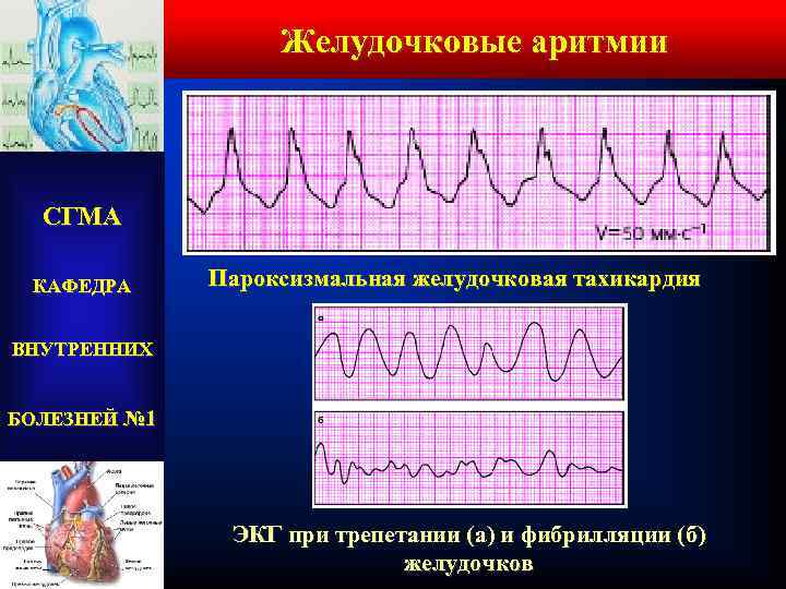 Желудочковые аритмии СГМА КАФЕДРА Пароксизмальная желудочковая тахикардия ВНУТРЕННИХ БОЛЕЗНЕЙ № 1 ЭКГ при трепетании