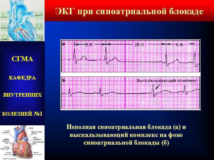 ЭКГ при синоатриальной блокаде СГМА КАФЕДРА ВНУТРЕННИХ БОЛЕЗНЕЙ № 1 Неполная синоатриальная блокада (а)