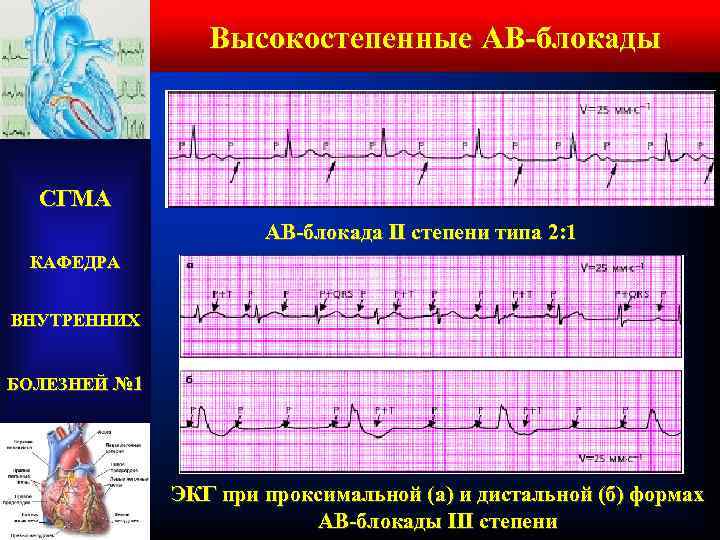 Высокостепенные АВ-блокады СГМА АВ-блокада II степени типа 2: 1 КАФЕДРА ВНУТРЕННИХ БОЛЕЗНЕЙ № 1