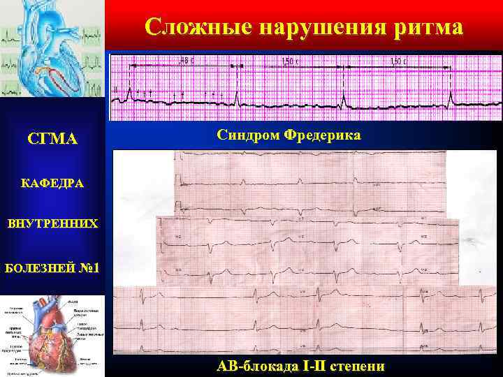 Сложные нарушения ритма СГМА Синдром Фредерика КАФЕДРА ВНУТРЕННИХ БОЛЕЗНЕЙ № 1 АВ-блокада I-II степени