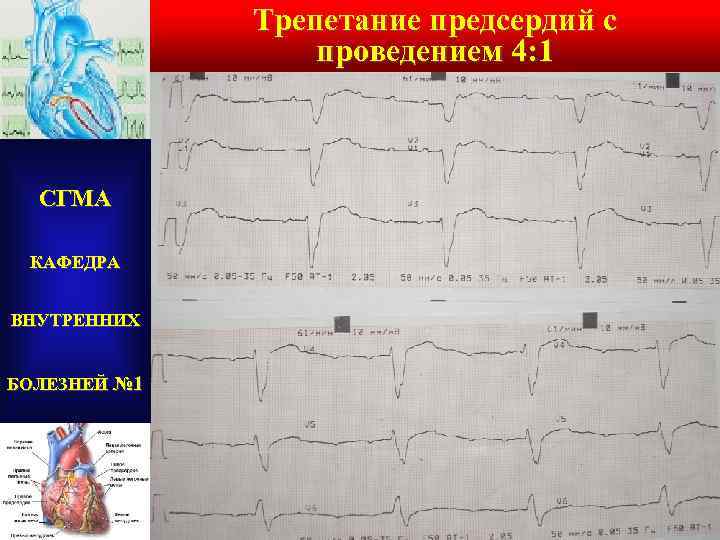 Трепетание предсердий с проведением 4: 1 СГМА КАФЕДРА ВНУТРЕННИХ БОЛЕЗНЕЙ № 1 