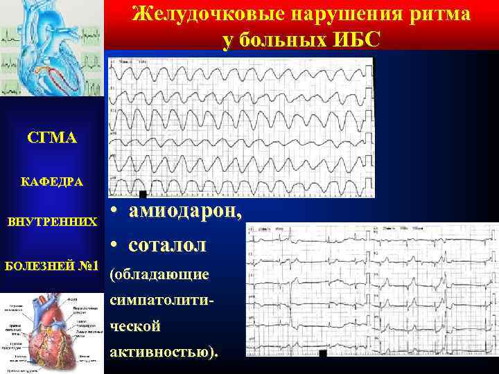 Желудочковые нарушения ритма у больных ИБС СГМА КАФЕДРА ВНУТРЕННИХ БОЛЕЗНЕЙ № 1 • амиодарон,