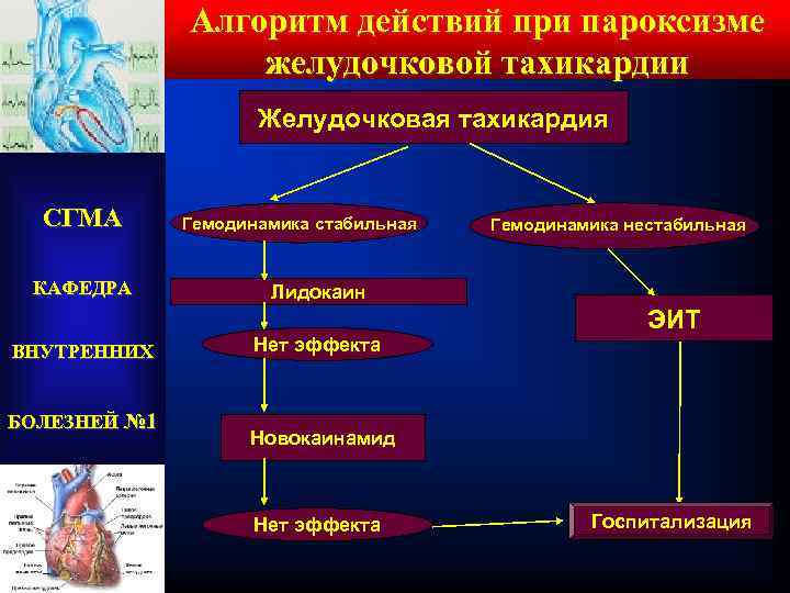 Алгоритм действий при пароксизме желудочковой тахикардии Желудочковая тахикардия СГМА КАФЕДРА ВНУТРЕННИХ БОЛЕЗНЕЙ № 1
