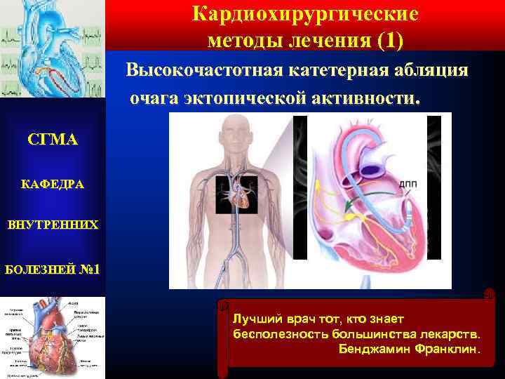 Кардиохирургические методы лечения (1) Высокочастотная катетерная абляция очага эктопической активности. СГМА КАФЕДРА ВНУТРЕННИХ БОЛЕЗНЕЙ