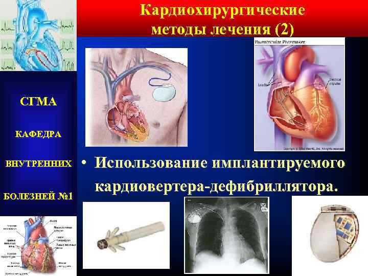 Кардиохирургические методы лечения (2) СГМА КАФЕДРА ВНУТРЕННИХ БОЛЕЗНЕЙ № 1 • Использование имплантируемого кардиовертера-дефибриллятора.