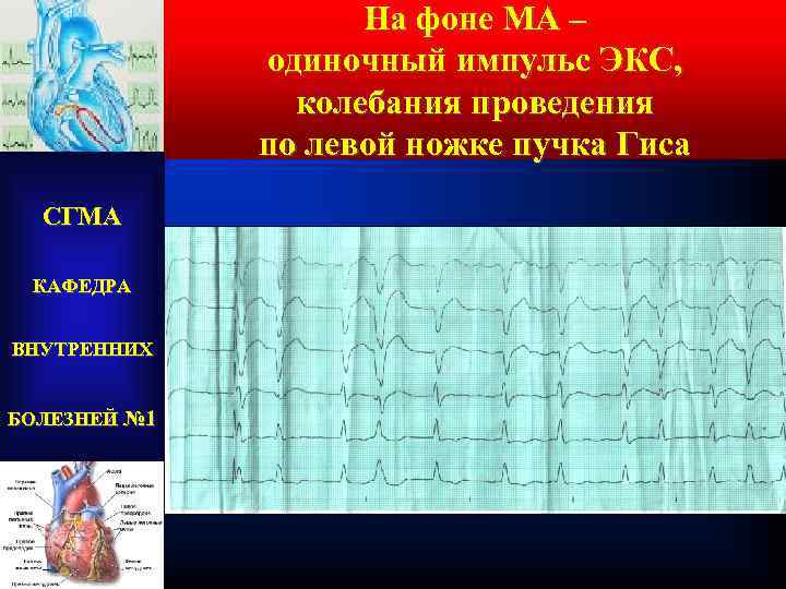 На фоне МА – одиночный импульс ЭКС, колебания проведения по левой ножке пучка Гиса
