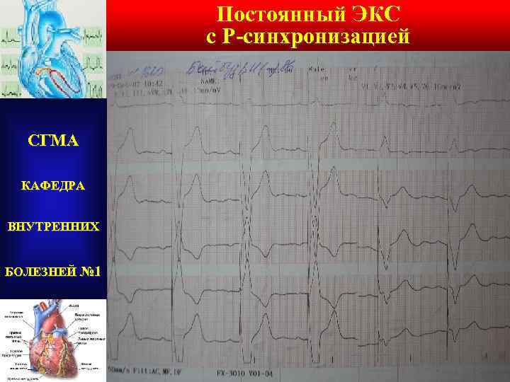 Постоянный ЭКС с Р-синхронизацией СГМА КАФЕДРА ВНУТРЕННИХ БОЛЕЗНЕЙ № 1 