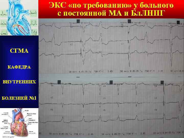 ЭКС «по требованию» у больного с постоянной МА и Бл. ЛНПГ СГМА КАФЕДРА ВНУТРЕННИХ