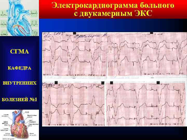 Электрокардиограмма больного с двукамерным ЭКС СГМА КАФЕДРА ВНУТРЕННИХ БОЛЕЗНЕЙ № 1 