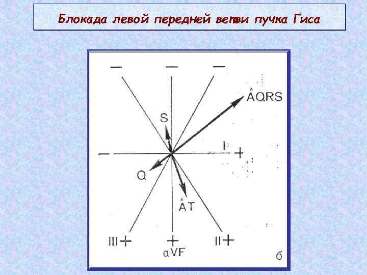 Блокада левой передней ветви пучка Гиса 