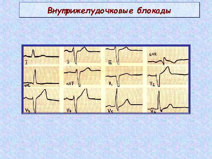 Внутрижелудочковые блокады 