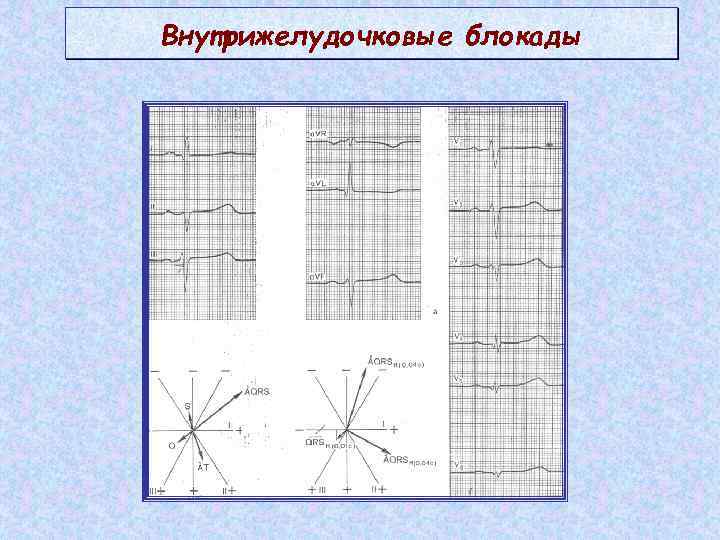 Экг блокады тест. Внутрижелудочковые блокады на ЭКГ. Локальная внутрижелудочковая блокада на ЭКГ. Блокада внутрижелудочкового проведения ЭКГ. Арборизационная блокада на ЭКГ.