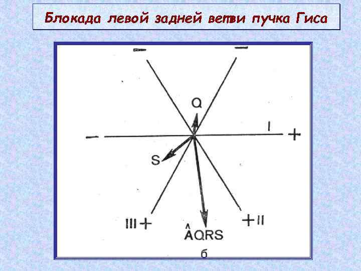 Блокада левой задней ветви пучка Гиса 