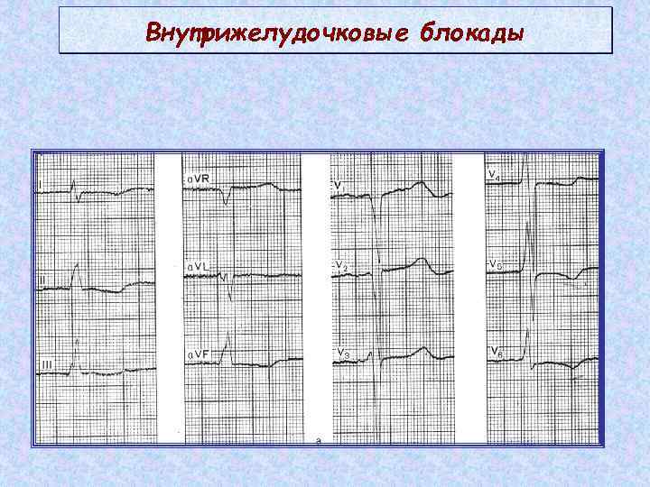 Внутрижелудочковые блокады 
