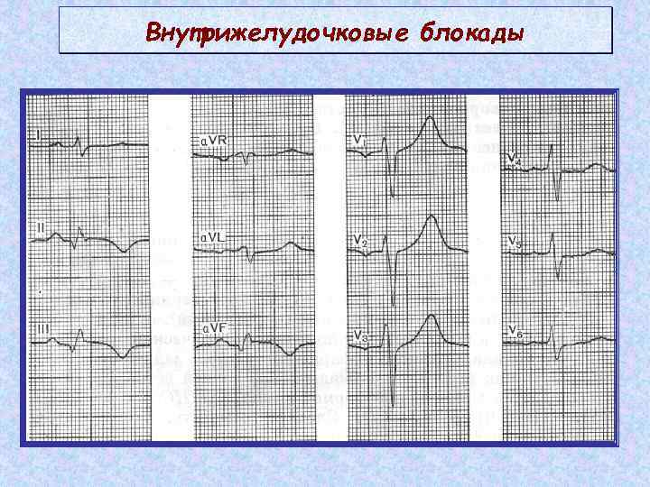 Внутрижелудочковые нарушения экг. Локальная внутрижелудочковая блокада на ЭКГ. ЭКГ при внутрижелудочковых блокадах. ЭКГ при нарушении внутрижелудочковой проводимости. Очаговая внутрижелудочковая блокада на ЭКГ.